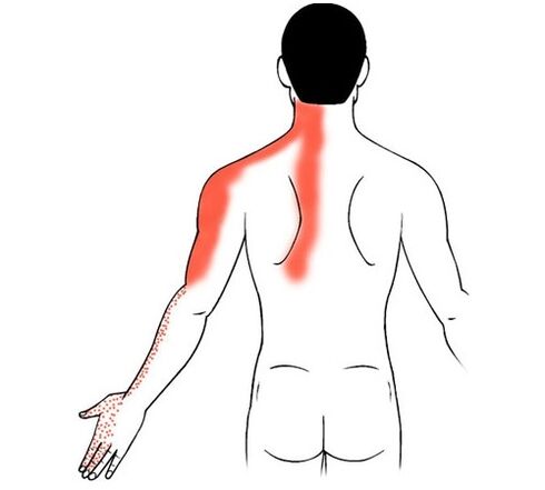 emakakaela osteokondroos kui valu põhjus sõrmede liigestes