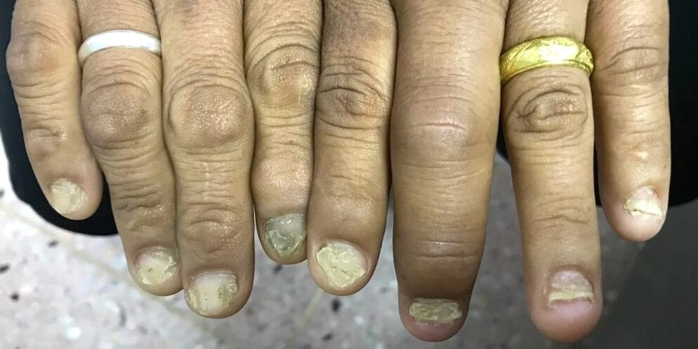 Sõrmede turse ja küüneplaadi deformatsioon võivad viidata psoriaatilise artriidi tekkele